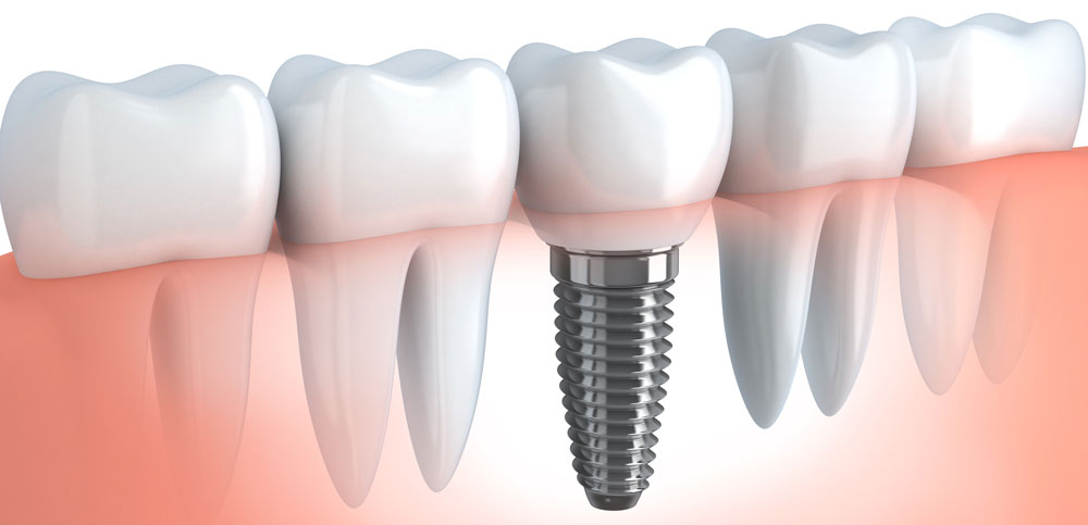 Dental implant services